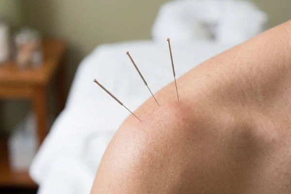 An extreme macro close-up shot focused on a human shoulder under diffused natural light. The composition reveals detailed skin texture with visible pores and three ultra-thin, sterile metallic acupuncture needles inserted diagonally. The sharpest focus is on the first needle insertion point, while a shallow depth of field causes the other needles and the white bedding in the background to softly blur, creating a clean, professional medical office aesthetic.