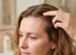 Close-up of flaky, scaly seborrheic dermatitis patches along an adult's hairline and eyebrow.