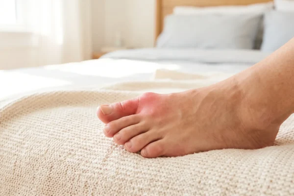 Close-up, eye-level composition of a bare foot resting on a textured cream blanket in a bright, airy bedroom. Soft, natural sunlight gently illuminates the scene, keeping the inflamed joint in sharp focus while a shallow depth of field creates a warm, softly blurred background. No text or logos are visible.
