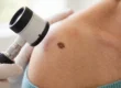A close-up photograph under soft, diffuse daylight of a patient's shoulder. Positioned centrally is a single, asymmetrical, dark, irregular skin mole on the textured skin of the shoulder. From the left, two hands in white medical gloves frame a hand-held dermatoscope, which is pointed directly at the mole for examination. The focus is sharp on the mole and the dermatoscope head. The skin of the shoulder shows natural texture and minor freckling. The background, including the partial back of a person with light hair and a window, is heavily blurred (shallow depth of field), creating a strong separation of the subject. No visible text or logos.